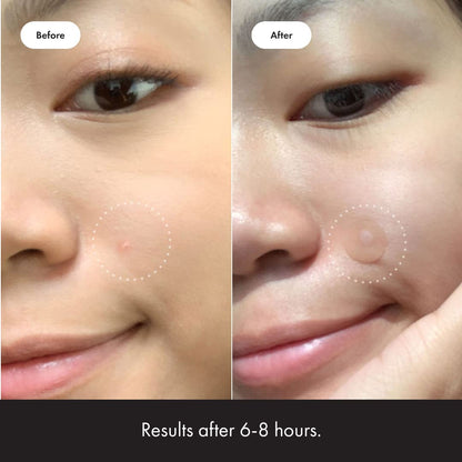 Hydrocolloid Acne Pimple Patch